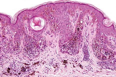 Fig. 25.77, Nevus of breast: the nests are large and dyscohesive.