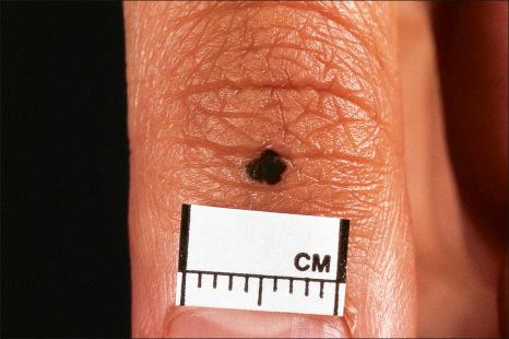 Fig. 25.79, Acral nevus: note the intense pigmentation and irregular border.