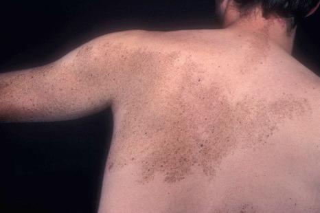 Fig. 25.86, Nevus spilus: in this patient, the lesion has a segmental distribution. This type of lesion is associated with an increased risk of developing melanoma.