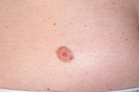 Fig. 25.87, Cockarde nevus: note the characteristic targetoid appearance.