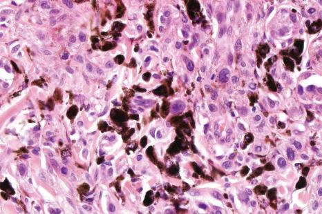 Fig. 25.90, Combined nevus: high-power view of admixed banal and dendritic cells with conspicuous melanophages.