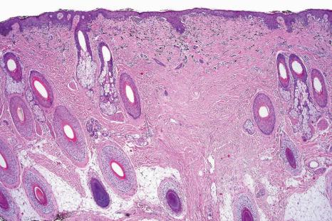 Fig. 25.92, Recurrent nevus: there is dense dermal scarring with an overlying predominantly junctional melanocytic proliferation. Dermal melanophages are conspicuous.