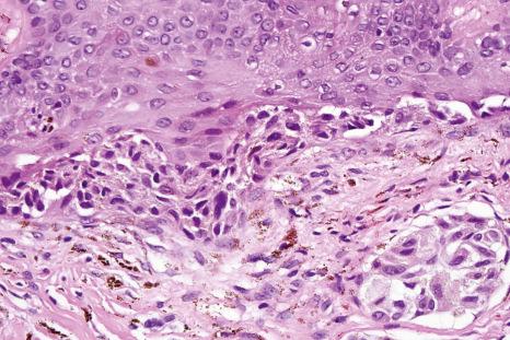 Fig. 25.94, Recurrent nevus: there is bridging, and cytological atypia is present in both junctional and dermal components. In cases of doubt, review of the previously excised lesion is advised.