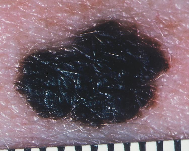 FIGURE 188-3, Superficial spreading melanoma.