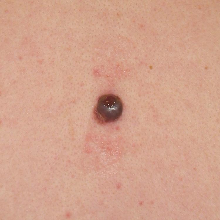 FIGURE 188-5, Nodular melanoma.