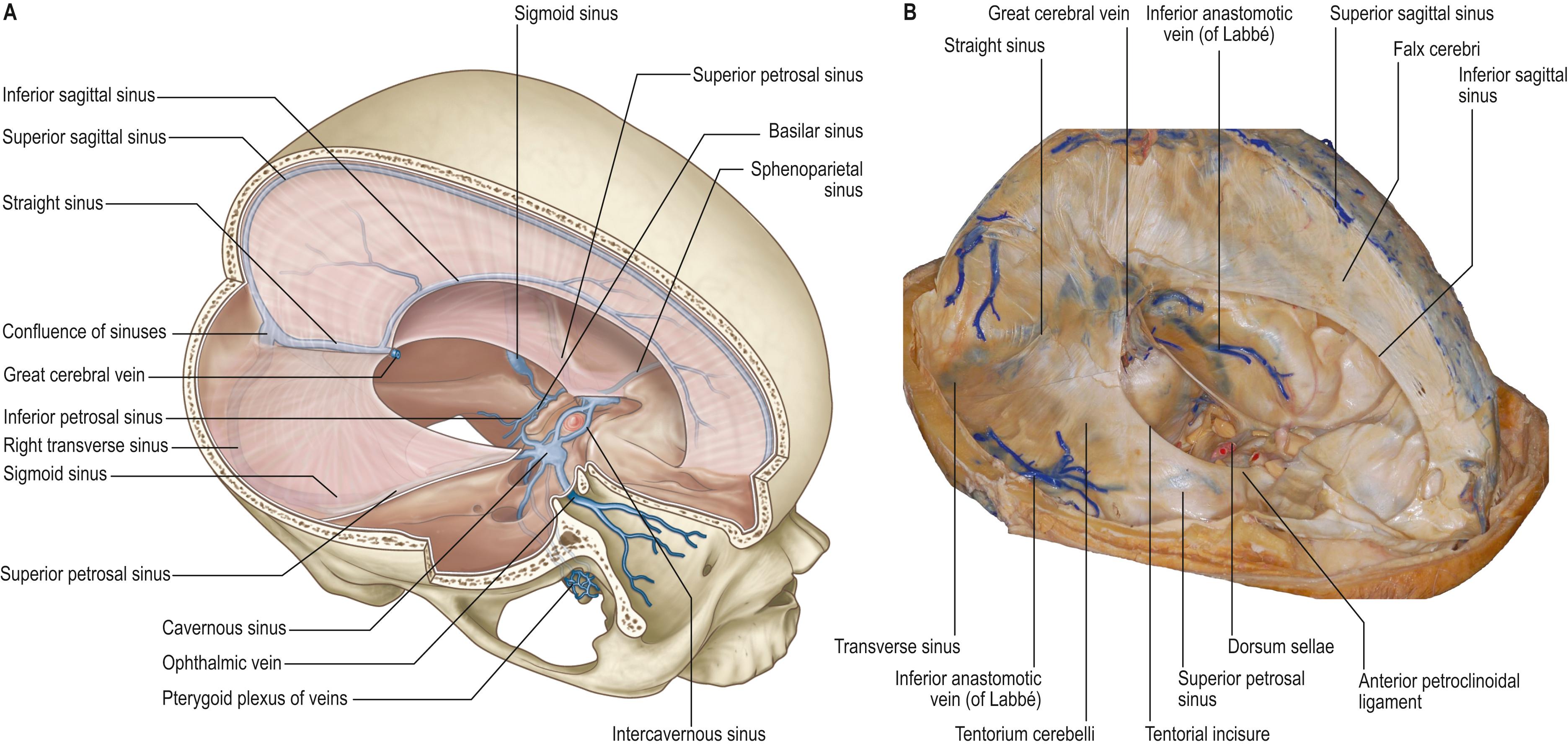 Fig. 25.2, A , The cerebral dura mater, its reflections and associated major venous sinuses. B , An anatomical dissection of a silicon-injected specimen.