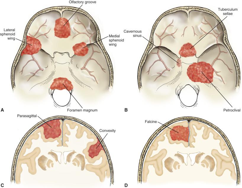 Fig. 13.1, Common locations for meningiomas. Common sites of tumor growth in relationship to adjacent skull, brain, and dural reflections (A–D). Illustrations created by MedPIC at Washington University School of Medicine with additional input from Dr. Michael Chicoine, Department of Neurosurgery.