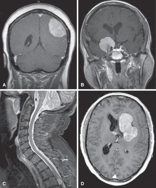 Fig. 13.2, Common meningioma sites and appearances on MRI. (A) Convexity meningioma on contrast T1-weighted MRI. Note the extra-axial location, uniform contrast enhancement, and “dural tail” sign, with mass effect causing compression of occipital horn of lateral ventricle. (B) Sphenoid wing meningioma on contrast T1-weighted MRI. Uniformly contrast-enhancing extra-axial mass centered on sphenoid wing and pushing adjacent frontal and temporal lobes. (C) Spinal cord meningioma on T2-weighted MRI. This thoracic cord meningioma (lower image) pushes and compresses the spinal cord posteriorly. The normal rim of bright CSF is displaced by the tumor and compressed cord. (D) Intraventricular meningioma on contrast T1-weighted MRI. A large homogeneously enhancing intraventricular meningioma fills the left lateral ventricle.