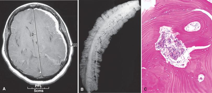 Fig. 13.3, (A) En plaque meningioma on contrast T1-weighted MRI. Thin, carpet-like meningioma involving a large portion of the left convexity. There is marked associated cerebral edema with midline shift. (B) Skull x-ray from a meningioma specimen with bone invasion. Note the extensive hyperostosis associated with bone thickening and a “sunburst” pattern of new bone formation. (C) Hyperostotic bone. Thickened lamellar bone with replacement of marrow space by aggregates of meningioma.