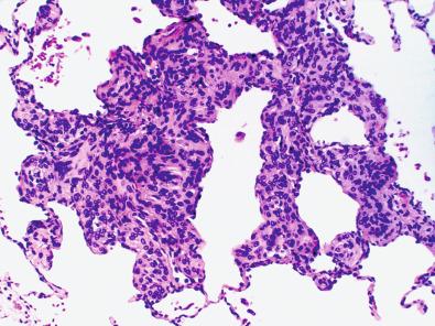 Fig. 13.4, Minute meningothelial pulmonary nodules. Interstitial lung nodules with aggregates of meningothelial-like cells.