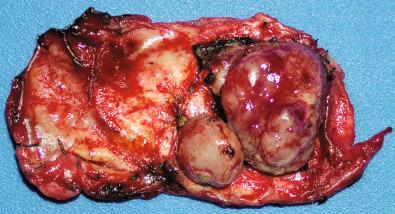 Fig. 13.5, “Multicentric meningioma” resection specimen. This large dural resection specimen showed a primary tumor nodule (far right) with a nearby satellite nodule, likely representing intradural spread of tumor.