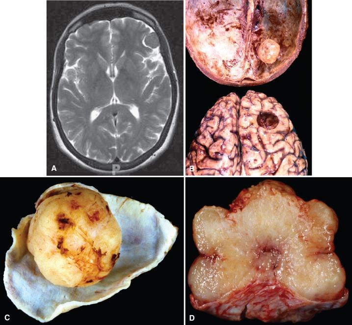 Fig. 13.6, (A) Incidental meningioma on T2-weighted MRI. The extra-axial appearance of this meningioma is well demonstrated by the thin layer of T2 bright CSF between the tumor and the adjacent indented, but noninvaded brain parenchyma. (B) Benign meningioma on autopsy. This meningioma showed a classic attachment to the inner surface of the dura, with the adjacent compressed brain molded to the rounded contours of the slowly growing tumor. (C) Resected meningioma. The tumor is attached to the resected sleeve of dura and shows a smooth external surface. (D) Resected meningioma. The tumor shows central attachment to the dura below and a bosselated cut surface.