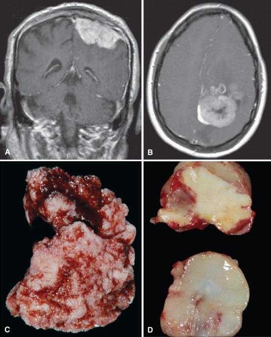 Fig. 13.7, (A) Atypical meningioma on contrast T1-weighted MRI. The enhancing extra-axial mass with dural tail sign is typical of meningioma, although the irregular brain–tumor interface is worrisome for a more aggressive subtype. (B) Anaplastic meningioma on contrast T1-weighted MRI. The irregular contour, inhomogeneous signal characteristics, and central hypodensity suggestive of necrosis are worrisome for higher grade. (C) Atypical meningioma. The soft fleshy appearance with focal papillary (cauliflower-like) configuration is worrisome for higher grade meningioma. (D) Anaplastic meningioma. Features worrisome of high grade include the soft, almost gelatinous cut surface suggesting high cellularity and the large yellow region of tumor necrosis evident in the upper fragment.