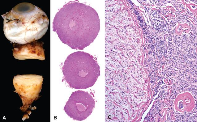 Fig. 13.8, Optic pathway meningioma in a patient with progressive visual loss/blindness. (A) Eye and optic nerve resection specimen. The optic nerve was markedly expanded by a circumferentially placed meningioma. (B) Eye and optic nerve resection specimen. Cross sections reveal a large meningioma surrounding and compressing a central atrophic optic nerve. (C) Optic nerve resection specimen. The optic nerve on the left is compressed, but not directly invaded by the meningioma on the right.