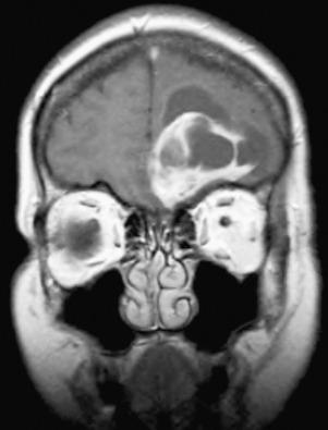 Fig. 13.9, Cystic meningioma on contrast T1-weighted MRI. This cystic meningioma was difficult to distinguish from a primary CNS neoplasm.