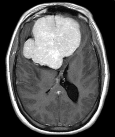 Fig 1, Meningioma. This postcontrast T1 MRI shows extensive growth of a bifrontal meningioma.