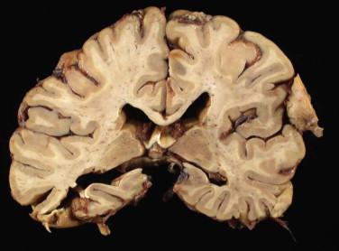 Fig 3, Meningioma. This gross image of the brain shows a right lateral convexity meningioma that compresses the adjacent brain.