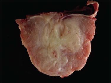 Fig 4, Meningioma. Meningiomas are typically firm, solid, well-circumscribed neoplasms that are attached to the dura ( upper right ).