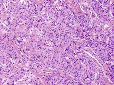 Fig 5, Meningioma. Tumor cells are arranged in distinctive whorls in the most common histologic pattern (meningothelial).