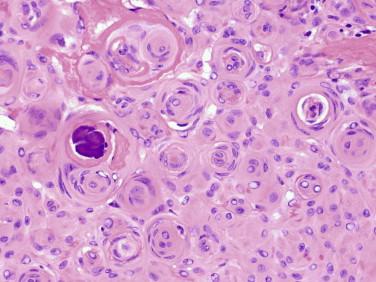 Fig 6, Meningioma. Meningothelial whorls and psammomatous calcifications ( left ) are classic features of the meningothelial variant. Bland oval nuclei, some of which contain prominent clearing or intranuclear cytoplasmic inclusions, are classic features of meningiomas.