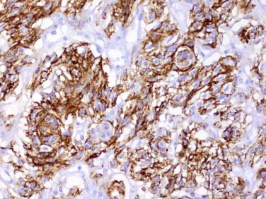 Fig 7, Meningioma. Meningiomas are immunoreactive for epithelial membrane antigen (EMA).