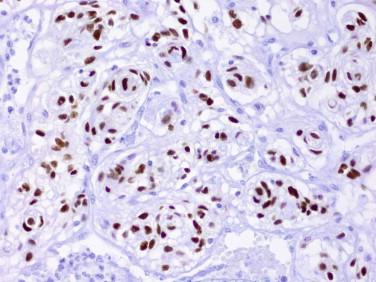 Fig 8, Meningioma. Immunoreactivity for progesterone receptors, as shown in this image, is observed in up to two thirds of meningiomas.