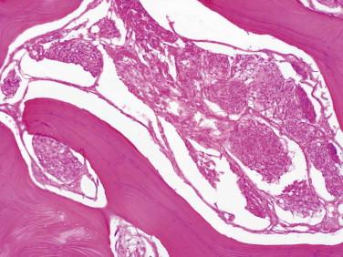 Fig 9, Meningioma. Bone invasion with hyperostotic reaction is a feature of some meningiomas.