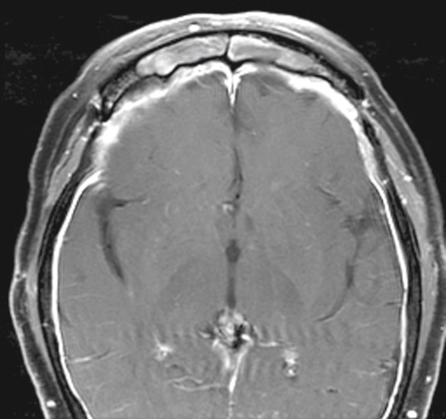 Figure 57.1, Recurrent meningitis due to persistent cerebrospinal fluid (CSF) leak through skull base.