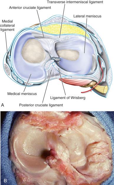 Fig. 94.1, Superior schematic (A) and cadaveric dissection (B) views of meniscal axial anatomy demonstrate the structural differences and specific attachment sites of the anterior and posterior horns of the medial and lateral meniscus.