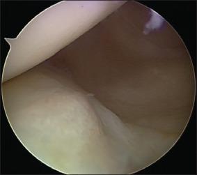 Fig. 94.11, An arthroscopic view in the posterior compartment of the knee with visualization of the posterior horn of the medial meniscus and the meniscotibial attachments.