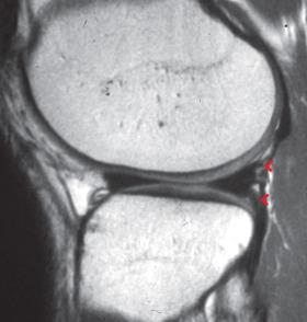 Fig. 94.2, A sagittal magnetic resonance imaging scan demonstrating the anatomic relationship of the superior and inferior popliteomeniscal fasciculi of the lateral meniscus (red arrowheads) .