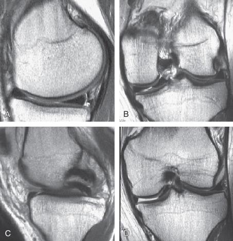 Fig. 94.5, Magnetic resonance imaging of the medial and lateral menisci. (A) A sagittal image demonstrates increased signal within the peripheral rim of the posterior horn of the medial meniscus, indicating a peripheral vertical meniscal tear. (B) A coronal view demonstrates a complex medial meniscal tear. (C) A double posterior cruciate ligament sign indicates a bucket handle meniscal tear displaced into the notch. (D) A coronal view demonstrates an absent posterior horn due to a displaced bucket handle tear that can be visualized in the notch.