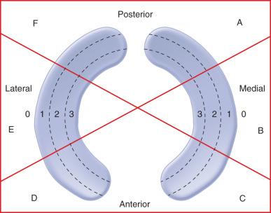 Fig. 94.7, Classification of a meniscal tear according to the anatomic position and vascularity.