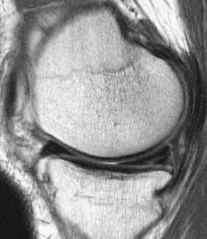 Fig. 94.8, A sagittal fat-suppressed magnetic resonance imaging slice demonstrates a grade III linear signal communicating with joint space through the inferior surface of the meniscus.