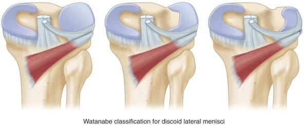 Fig. 94.9, The Watanabe classification for discoid lateral menisci.