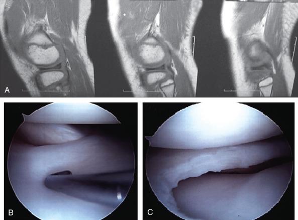 Fig. 94.10, Discoid lateral meniscus. (A) Diagnostic magnetic resonance imaging scans demonstrate absence of the classic “bow-tie” appearance of the lateral meniscus in three successive 5-mm cuts. (B) The arthroscopic view of a complete discoid lateral meniscus. (C) The arthroscopic view of a final saucerization procedure.