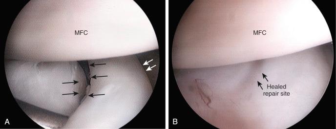 FIG 23-2, A, A double-longitudinal medial meniscus tear with a peripheral tear and another tear at the red-white junction. Removal of the red-white tear and repair of the peripheral tear would result in substantial loss of meniscus function; accordingly, a repair of both tears was performed. B, Complete healing of the tears on subsequent arthroscopy 1 year later. MFC, Medial femoral condyle.
