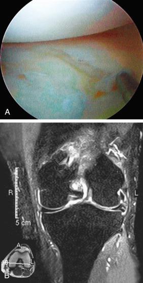 FIG 23-3, Examples of irreparable meniscus tears. A and B, A 40-year-old man with a complex middle third longitudinal tear of the lateral meniscus. C and D, A 39-year-old man with a complex flap tear to the posterior horn of the medial meniscus. E and F, A 43-year-old man with a degenerative tear extending to the under surface of the medial meniscus. G and H, A 55-year-old woman with a degenerative longitudinal tear to the medial meniscus. Magnetic resonance imaging does not provide sufficient detail of the tear and integrity of the meniscus tissue to determine if a repair of the complex tear is possible.