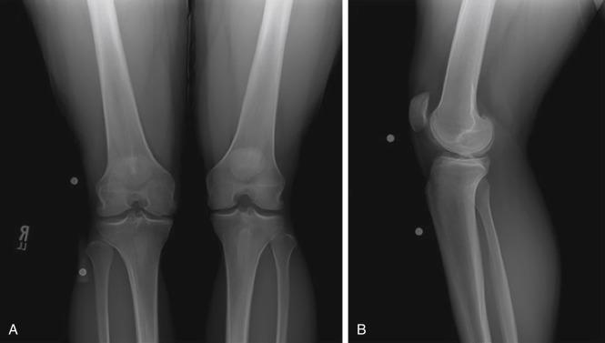 • Fig. 3.1, (A) Posteroanterior and (B) lateral radiographs with 10-cm sizing marker used to calculate a patient’s tibial dimensions for appropriate meniscus allograft sizing.