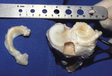 FIG 24-1, Visual inspection of meniscus transplant before implantation.