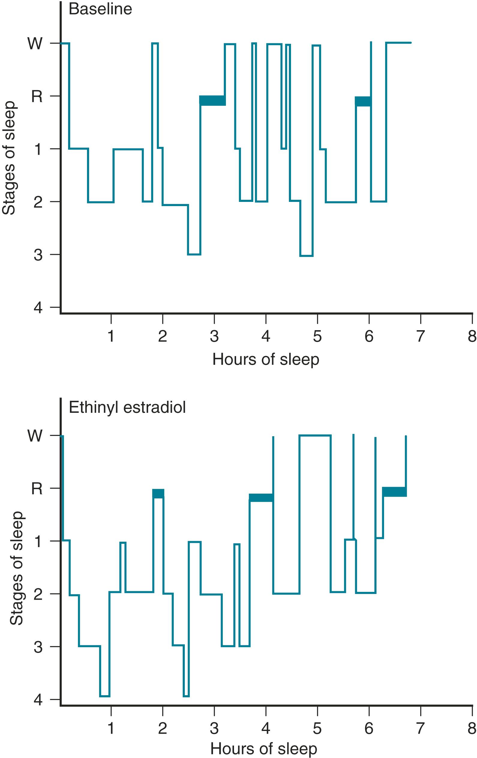 Fig. 14.21, Sleepgrams measured in symptomatic patient before and after 30 days’ administration of ethinyl estradiol, 50 μg 4 times daily.