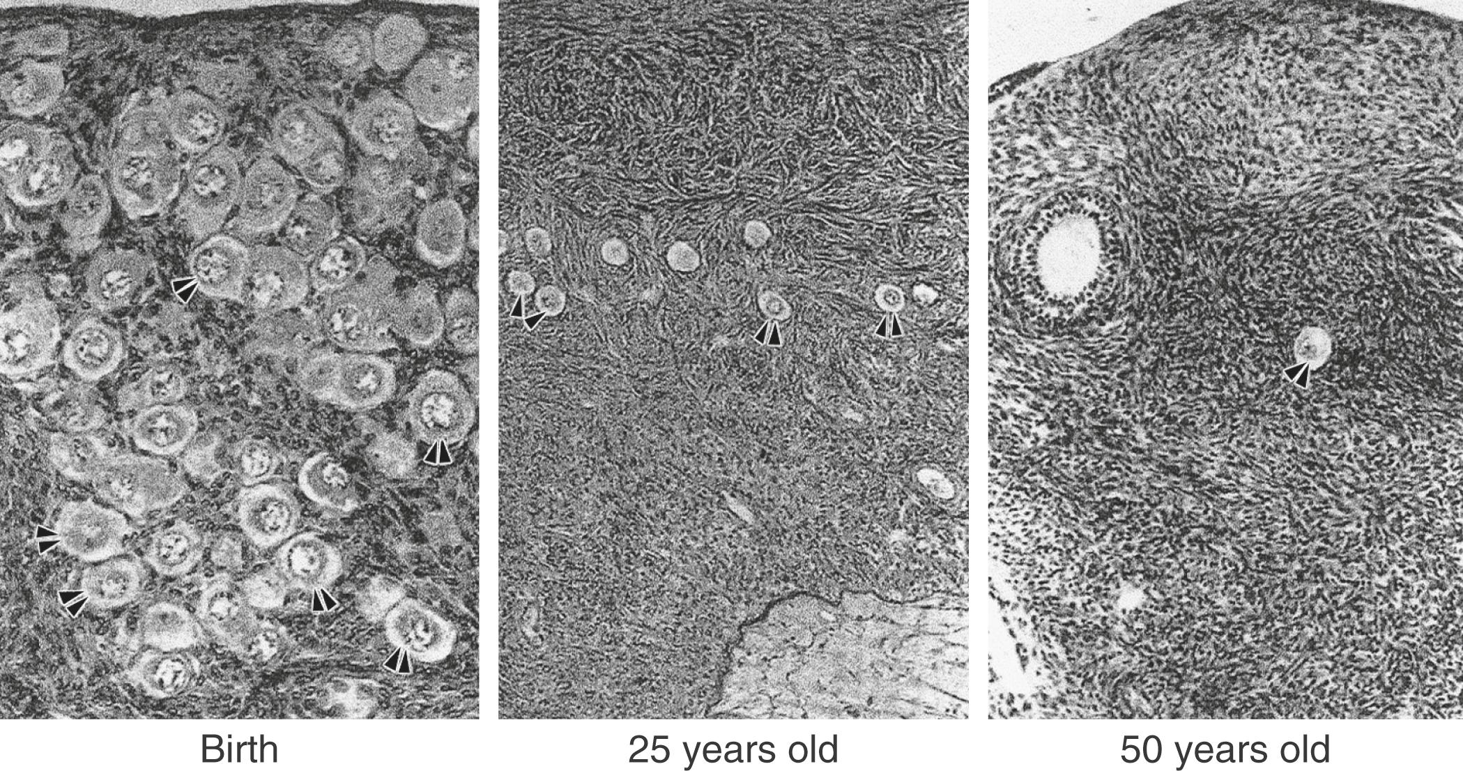 Fig. 14.3, Photomicrographs of the cortex of human ovaries from birth to 50 years of age.