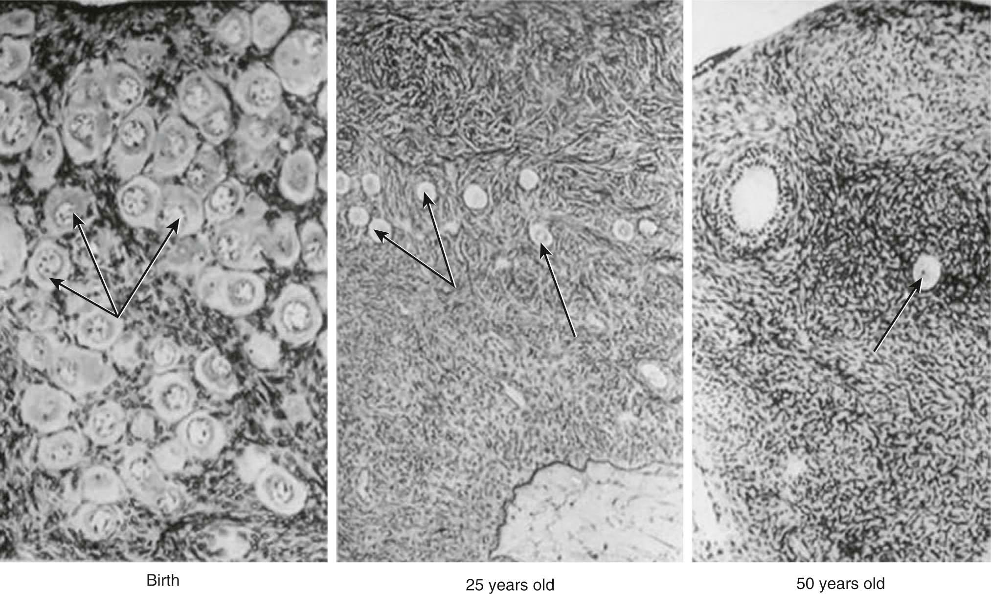 FIGURE 35-1, Histologic illustration of the density of oocytes (arrows) from birth to menopause. Note the abundance of eggs at birth and only an occasional one at or near menopause.