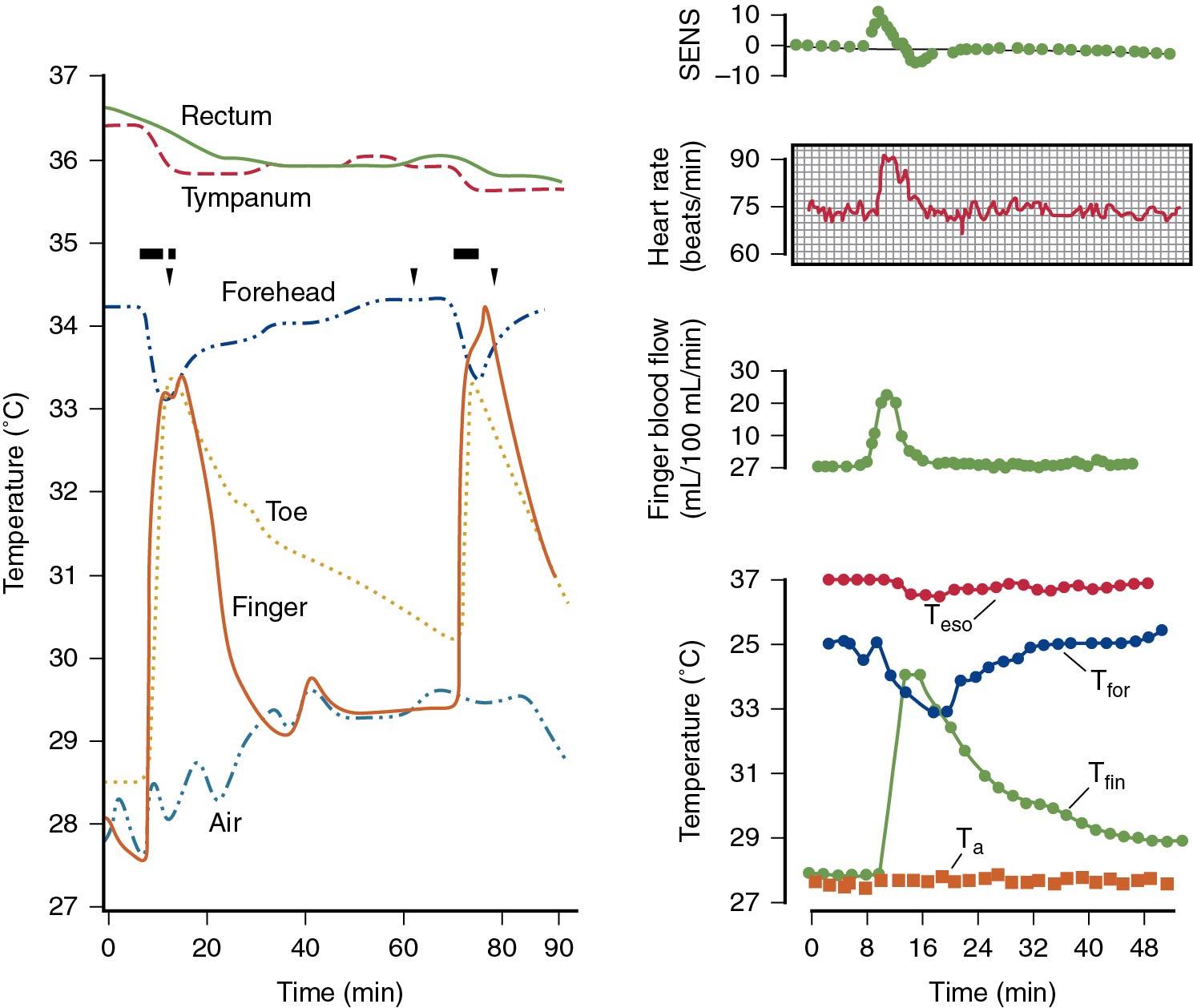 Fig. 14.19, Temperature responses to two spontaneous flashes and evoked flash. Down arrow indicates finger stab for blood sample. Black bars indicate time of flush. SENS, sensation; T fin , temperature at various places on the body.