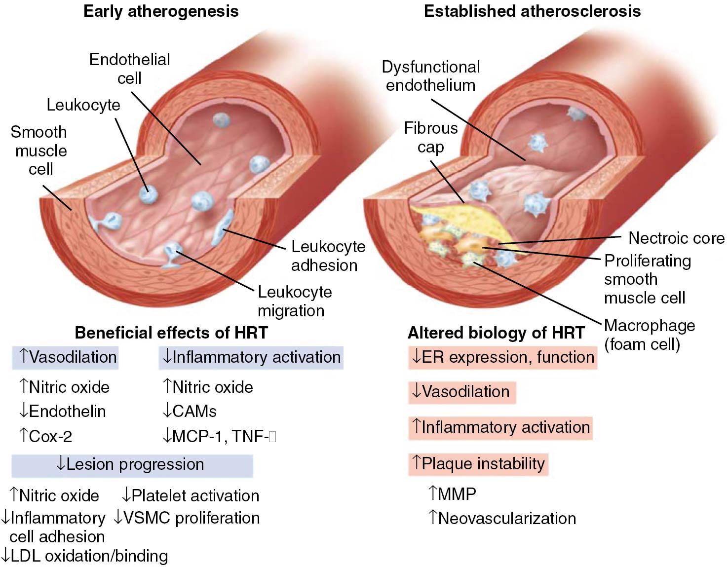 Fig. 14.24, Mechanisms of benefit of hormonal therapy with estrogen in early menopause (relatively clean coronary vessels) and the lack of effect in older women and those with significant atherosclerotic plaque burden. CAM, Cellular adhesion molecule; Cox-2, cyclooxygenase 2; ER, estrogen receptor; HRT, hormone replacement therapy; LDL, low-density lipoprotein; MCP-1, Macrophage chemoattractant protein -1; MMP, matrix metalloproteinase; TNF-α, tumor necrosis factor alpha; VSMC, vascular smooth muscle cell.