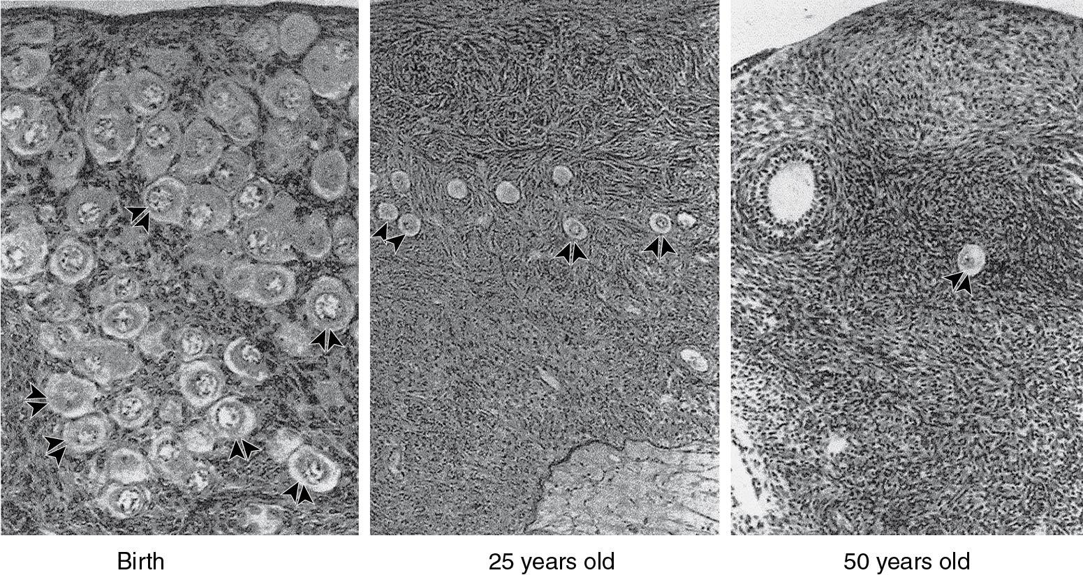 Fig. 14.3, Photomicrographs of the cortex of human ovaries from birth to age 50 years. Small nongrowing primordial follicles (arrowheads) have a single layer of squamous granulosa cells.