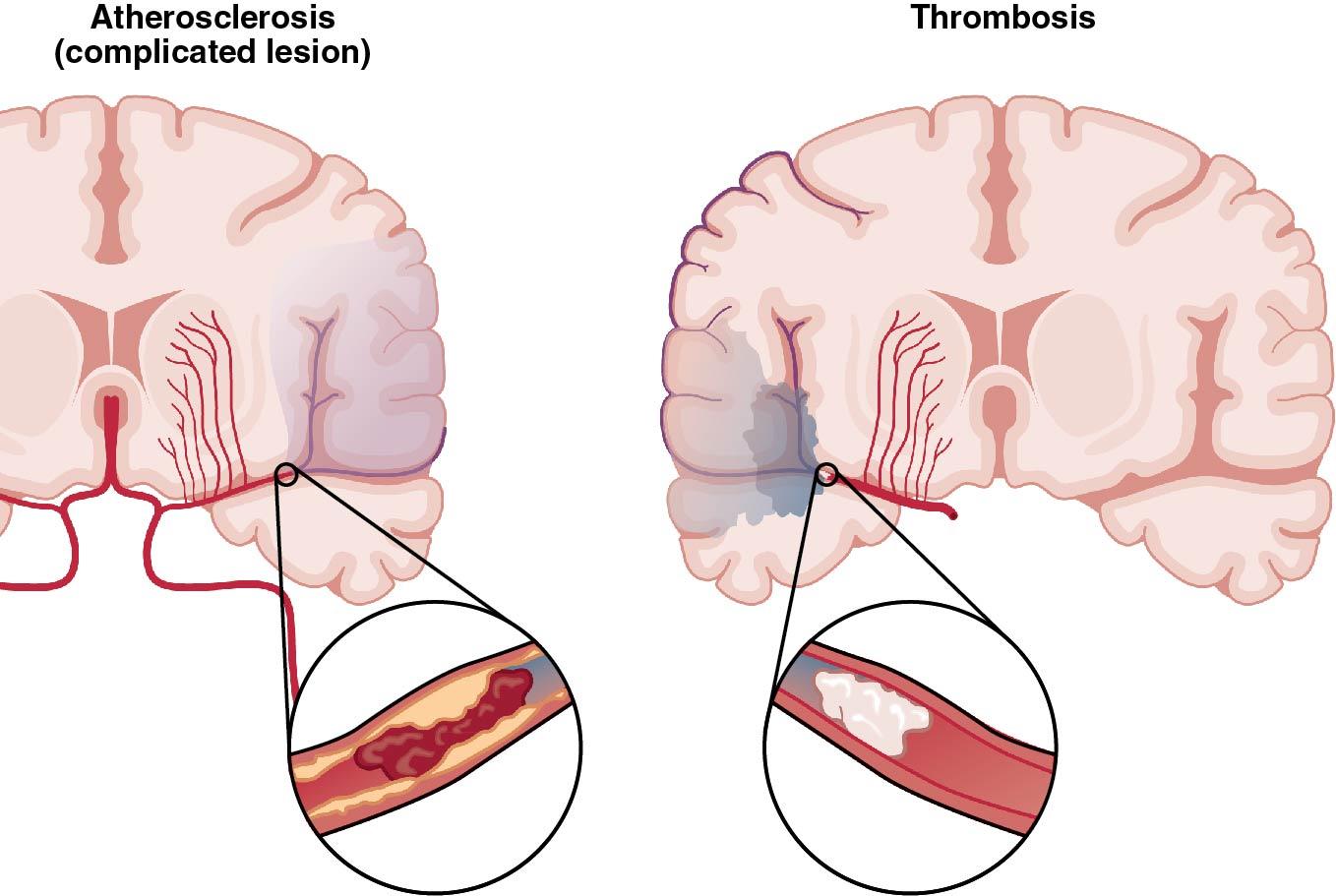 Fig. 14.34, Mechanisms of ischemic stroke risk with estrogen in older women as a result of atherosclerosis with complicated lesions (left) and as a result of thrombosis in younger women (right).