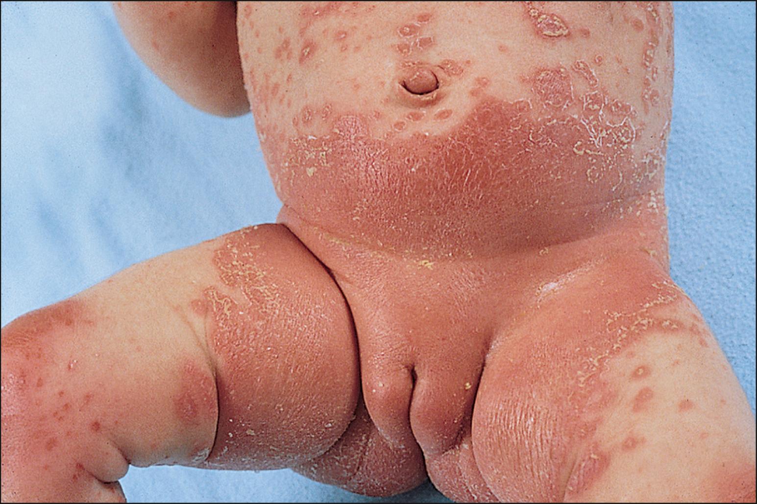 Fig. 25.1, Psoriasis: typical diaper involvement.