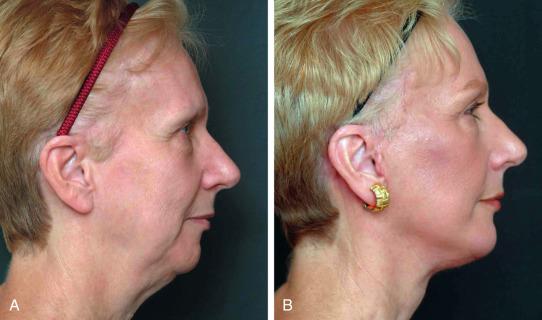 Figure 22.1, (A) Preoperative and (B) 6-month postoperative views of a patient who underwent mentoplasty with a medium extended anatomical chin implant and facelift.