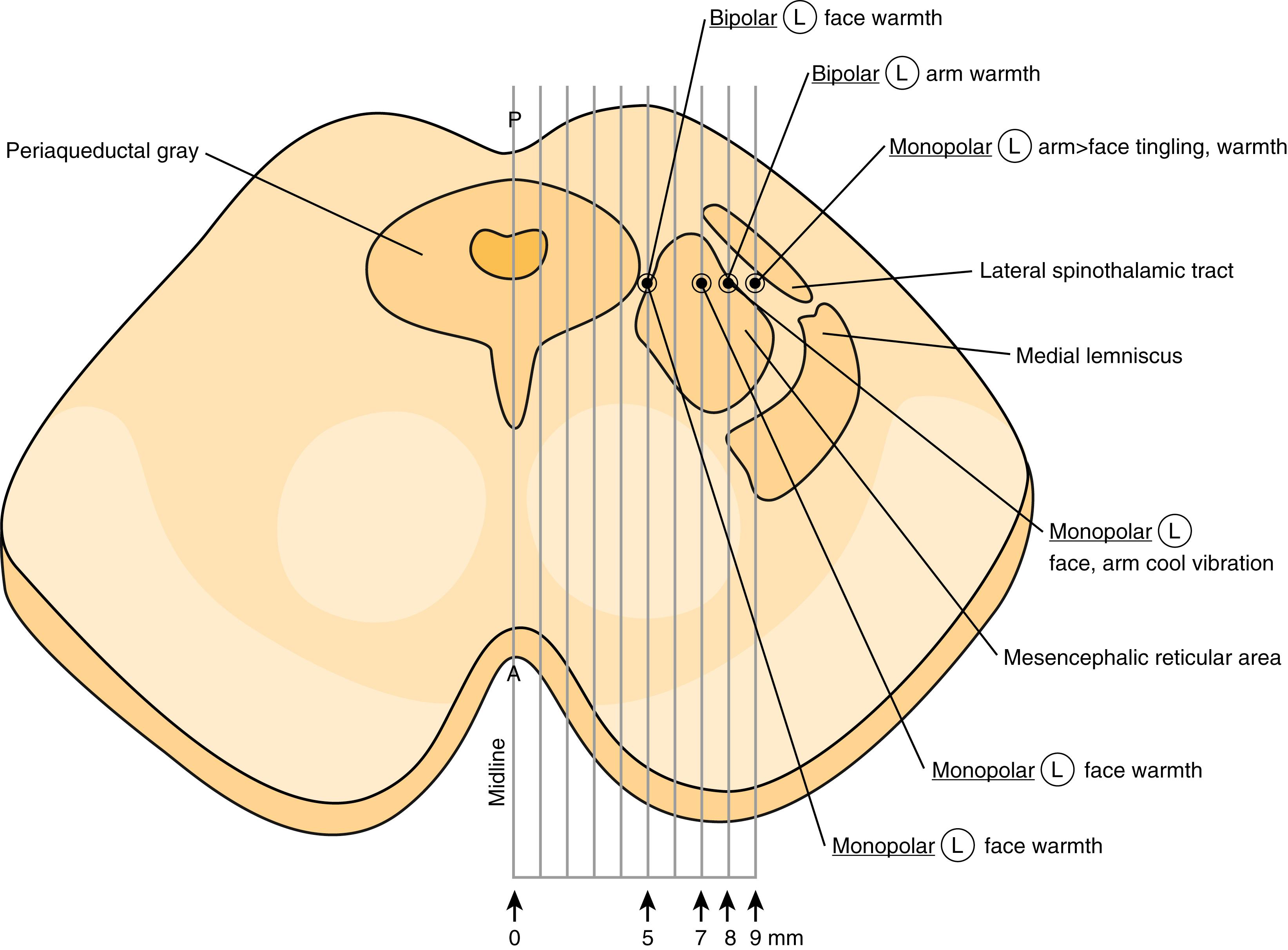 FIGURE 118.1, Schematic diagram of the midbrain at the level of the superior colliculus, demonstrating the anatomic location and the somatotopic organization of the lateral spinothalamic tract. Note also the anatomic location of the usually elicited responses during electrophysiological stimulation.